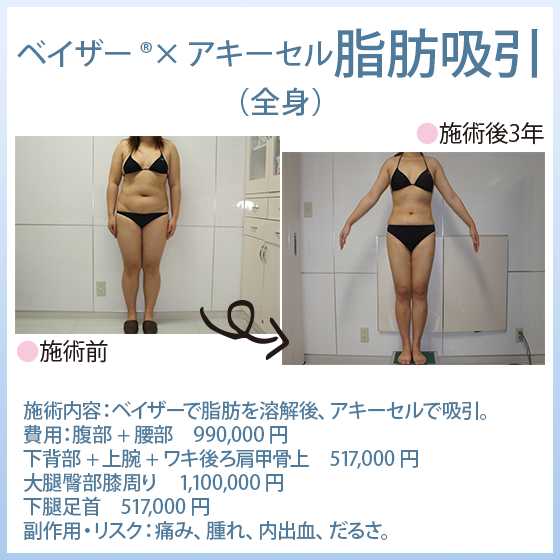 「ベイザー®脂肪吸引×アキーセル脂肪吸引」 全身の脂肪吸引